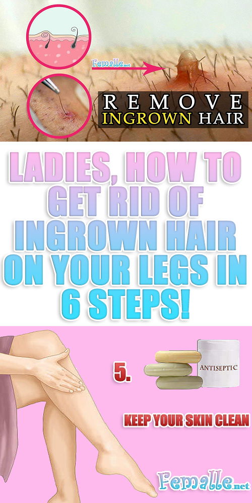 Ladies, How to Get Rid of Ingrown Hair on your Legs In 6 Steps