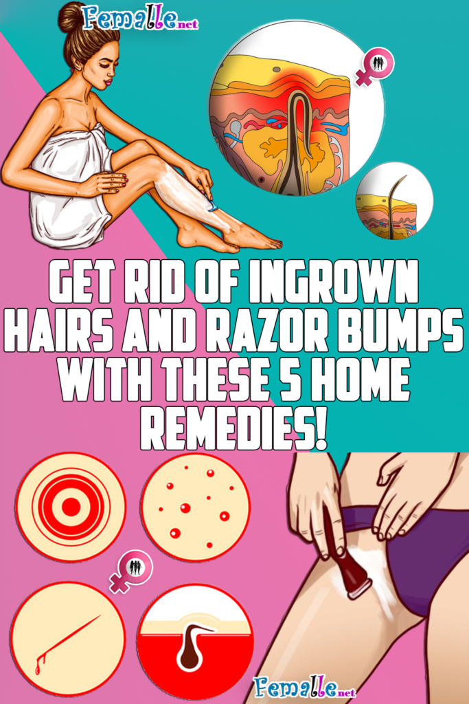 Eliminate Ingrown Hairs and Razor Bumps: 5 Home Remedies to Try