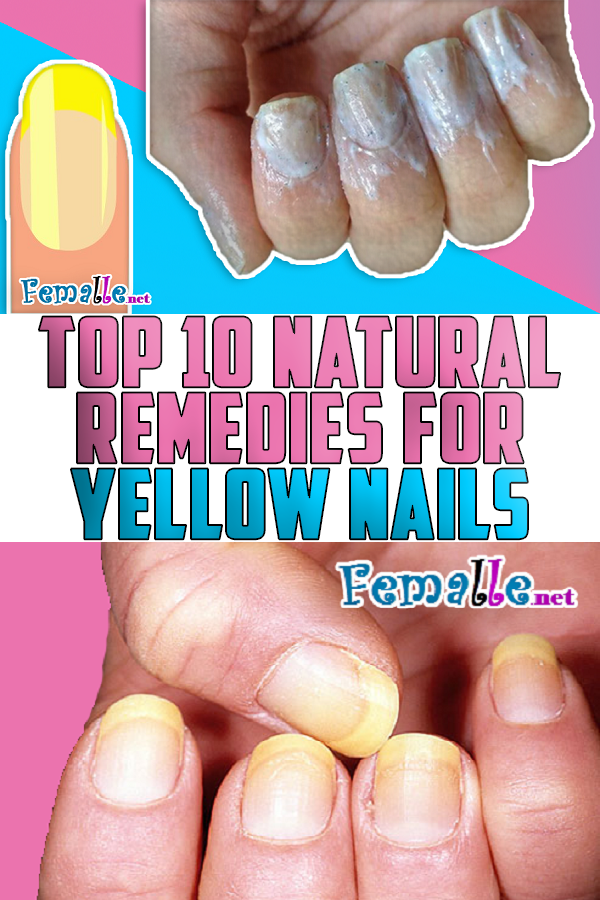 Top 10 Natural Remedies For Yellow Nails